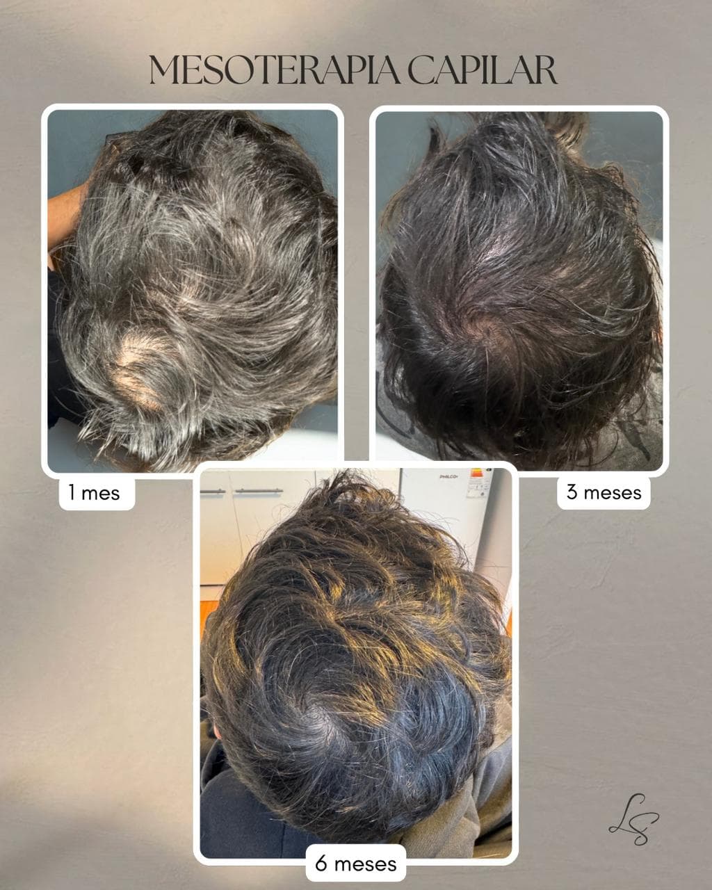 Resultados: Mesoterapia Capilar